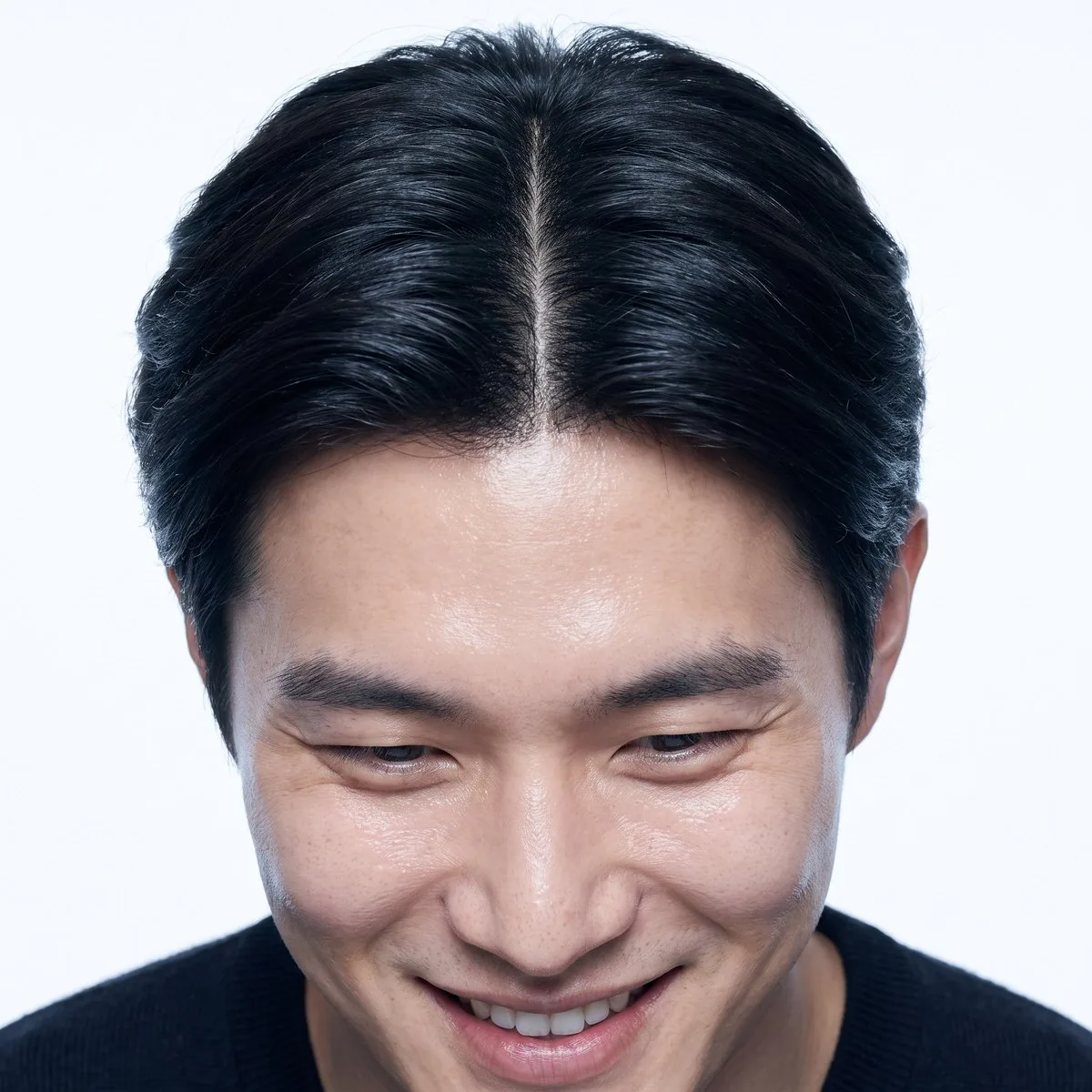 Close-up of a narrow dense part line after hair restoration at BHRC