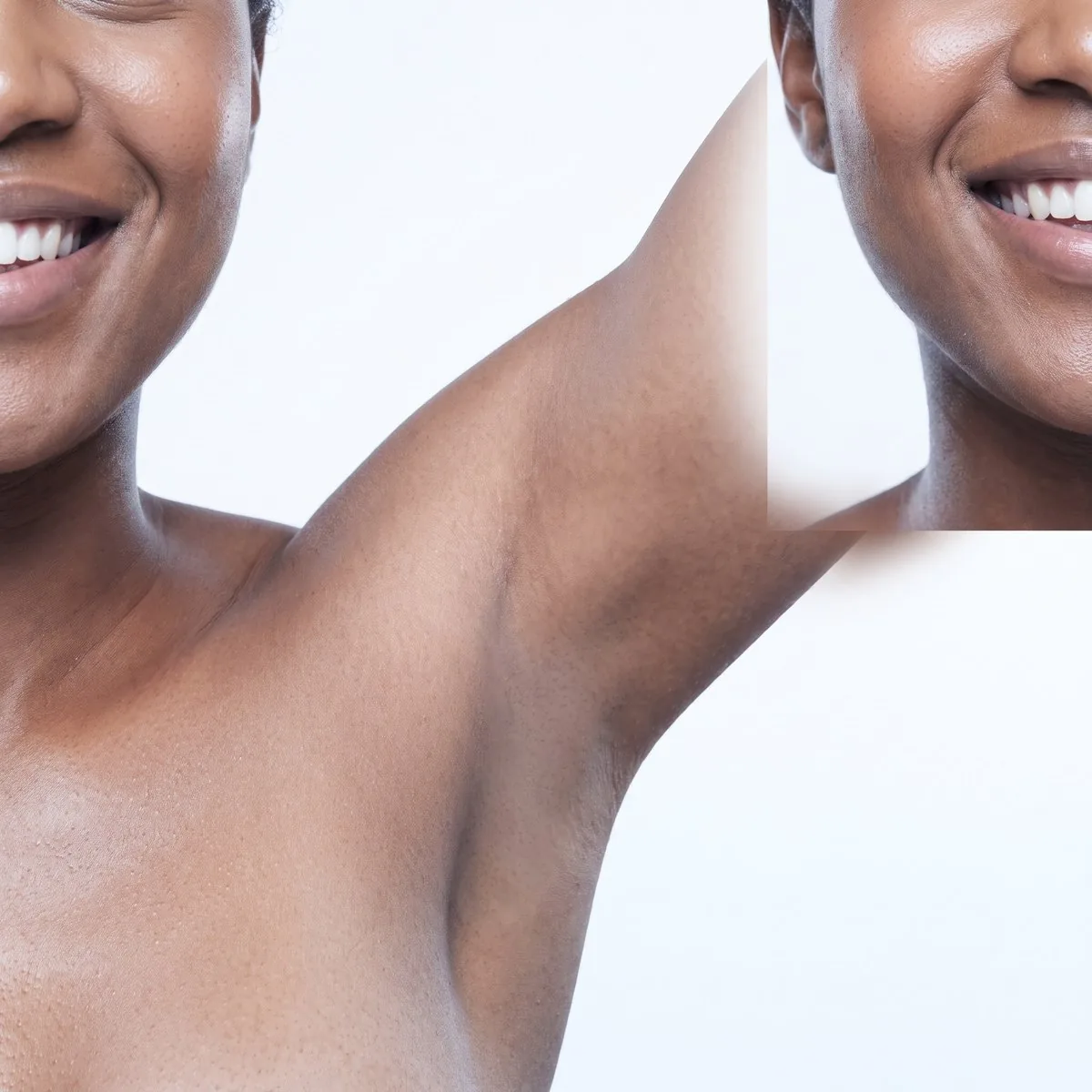 Smooth underarm skin after laser hair removal at BHRC