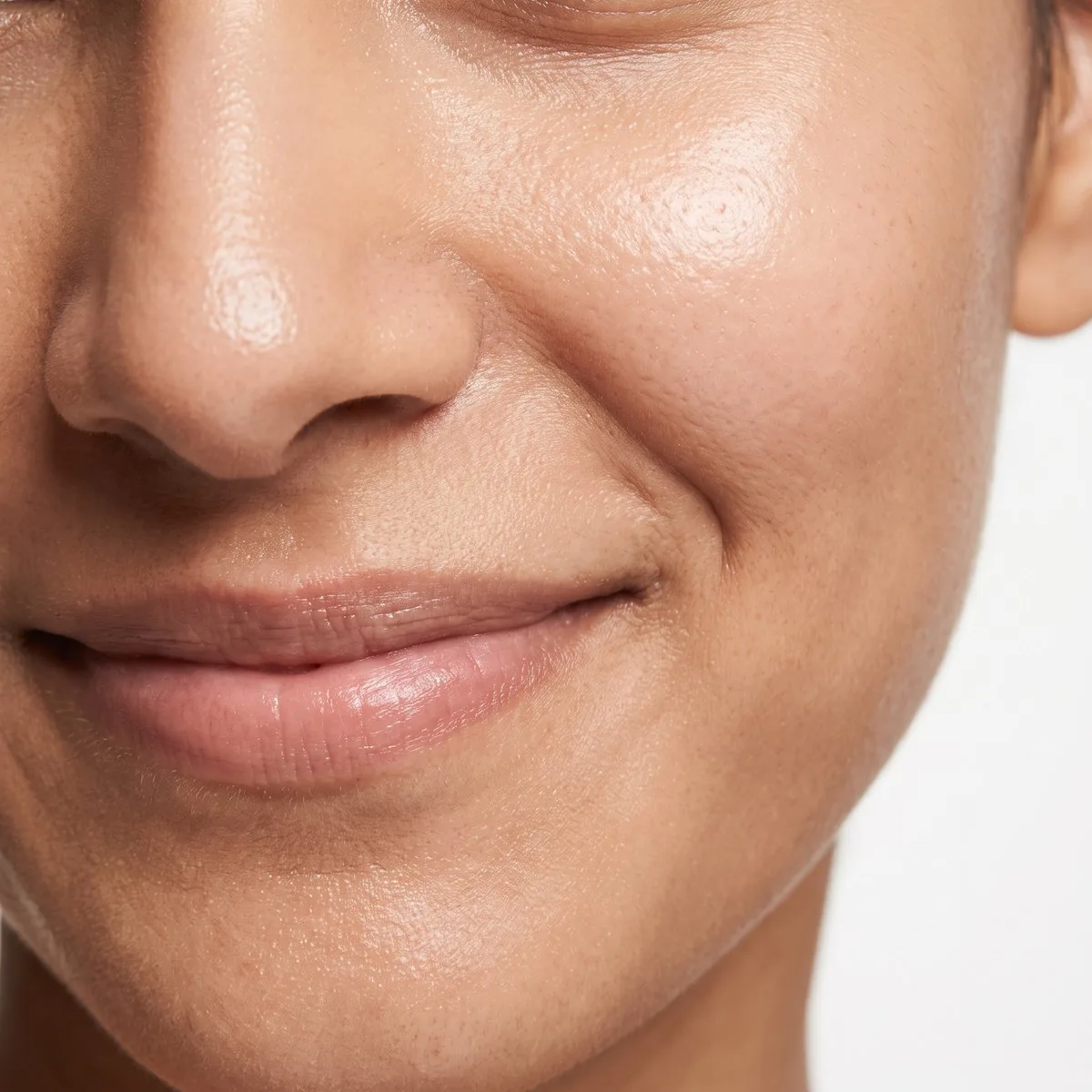 Close-up of softened nasolabial folds after filler at BHRC