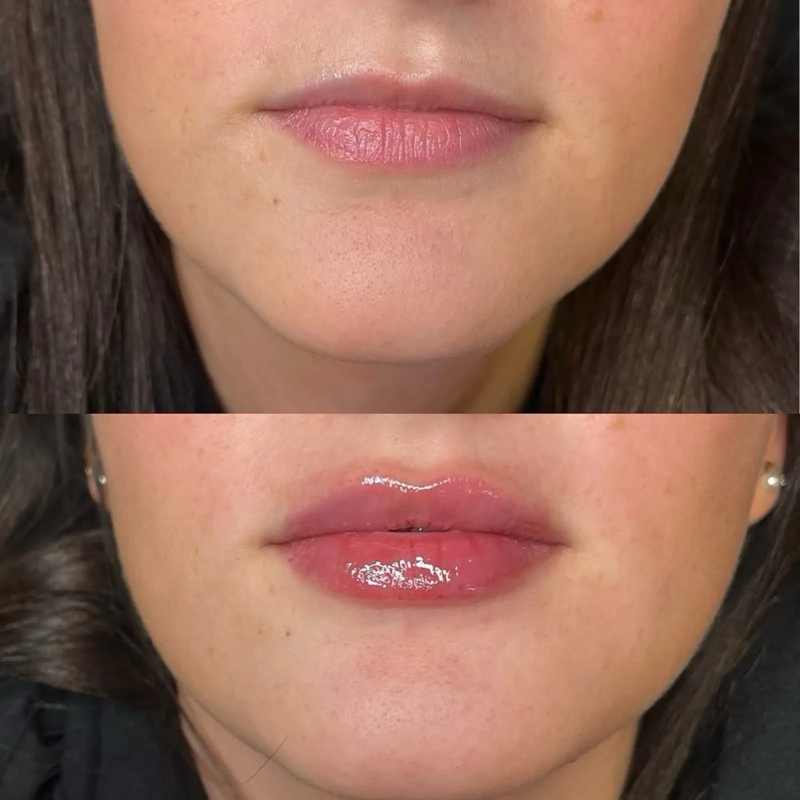 Before and after lip filler at BHRC, added body and definition