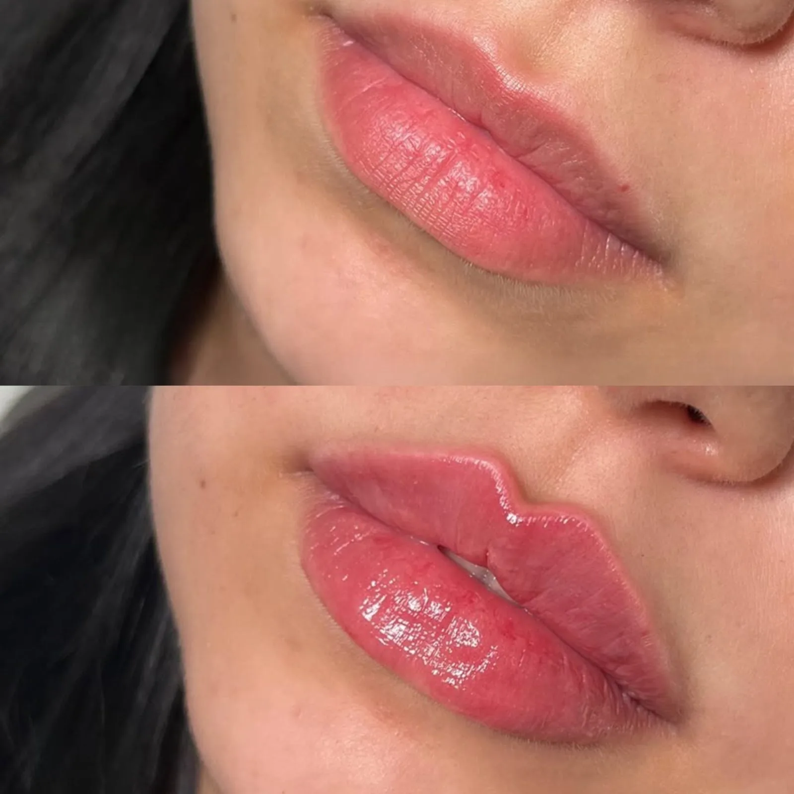 Before and after lip filler at BHRC, improved symmetry
