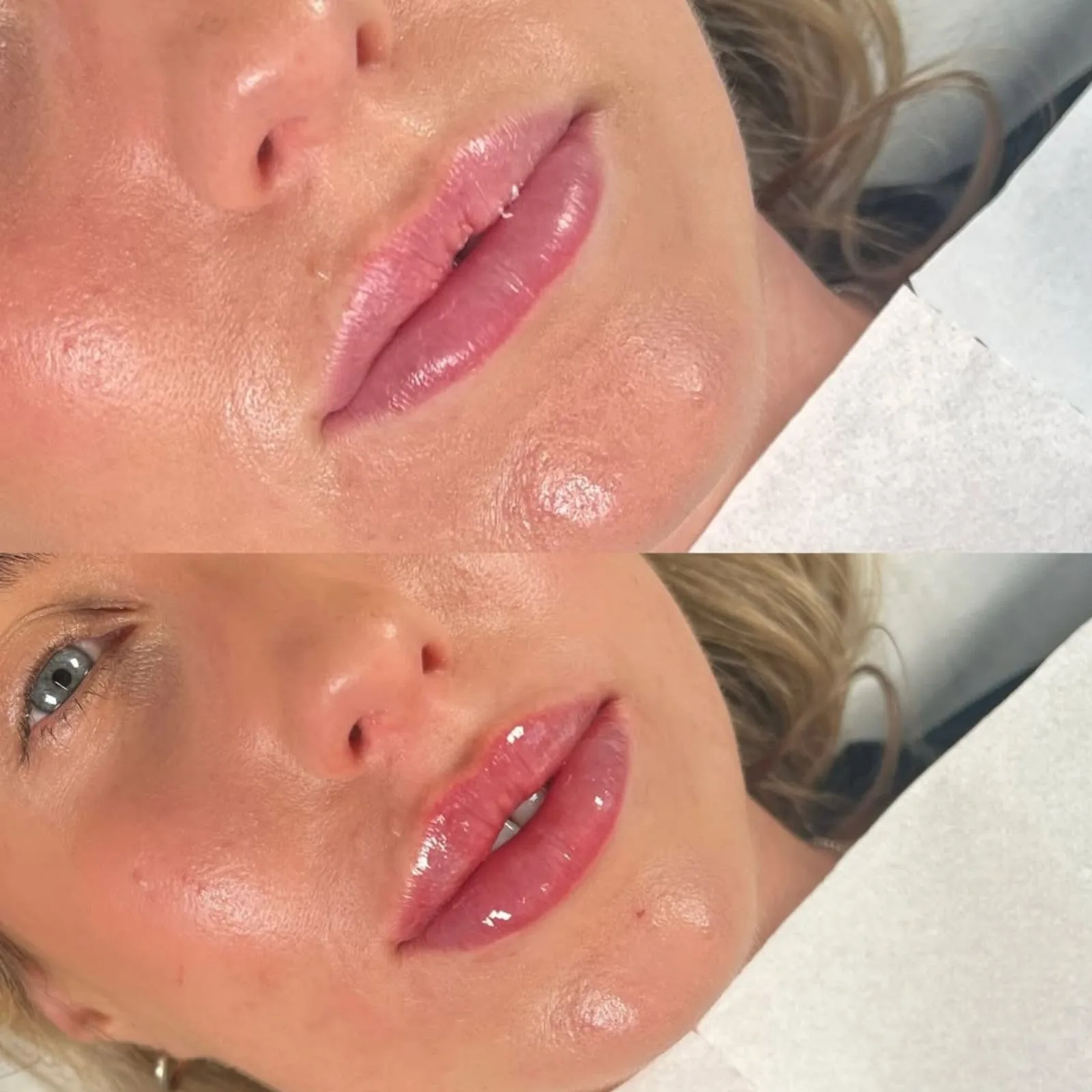 Before and after lip filler at BHRC, fuller upper and lower lip
