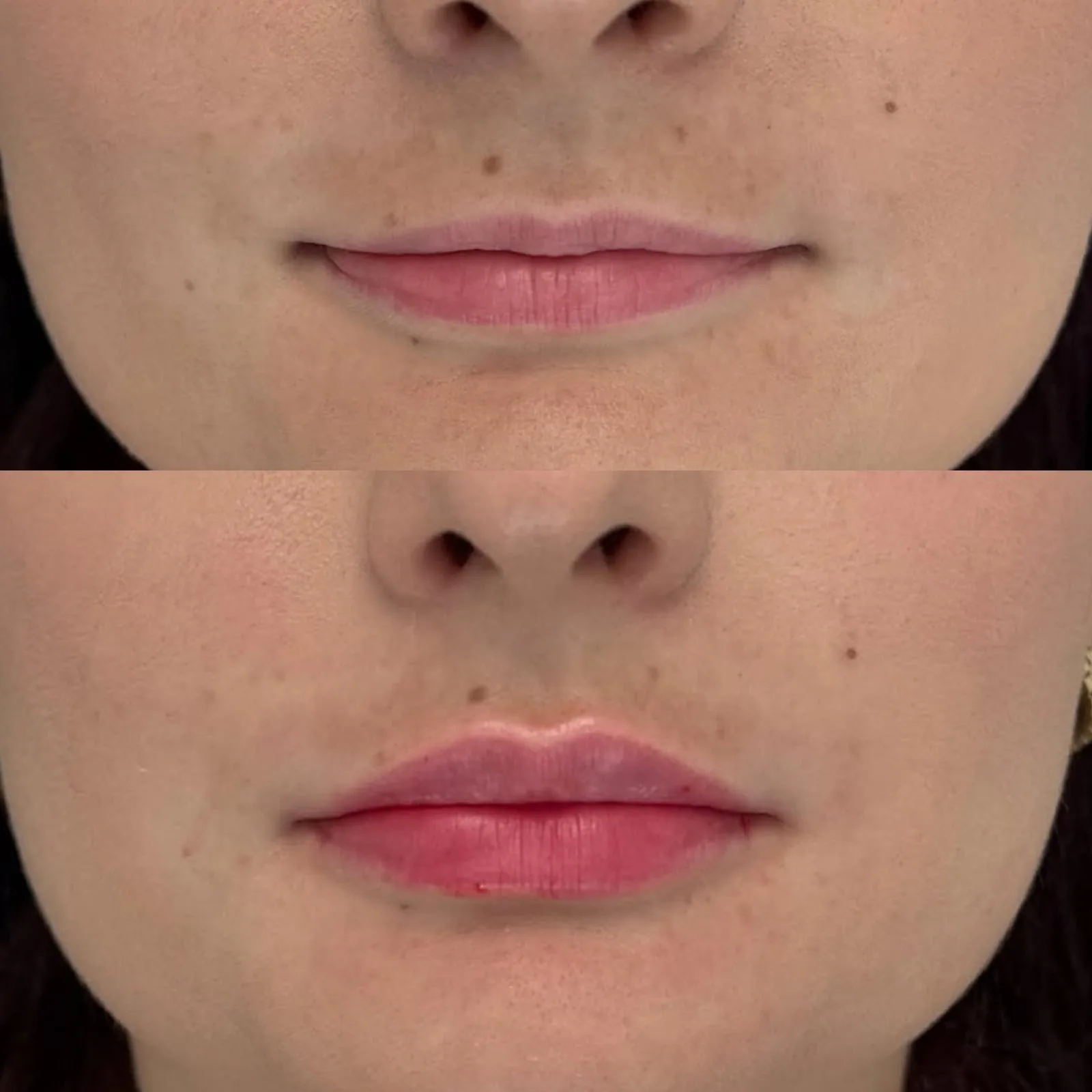 Before and after lip filler at BHRC, defined cupid's bow