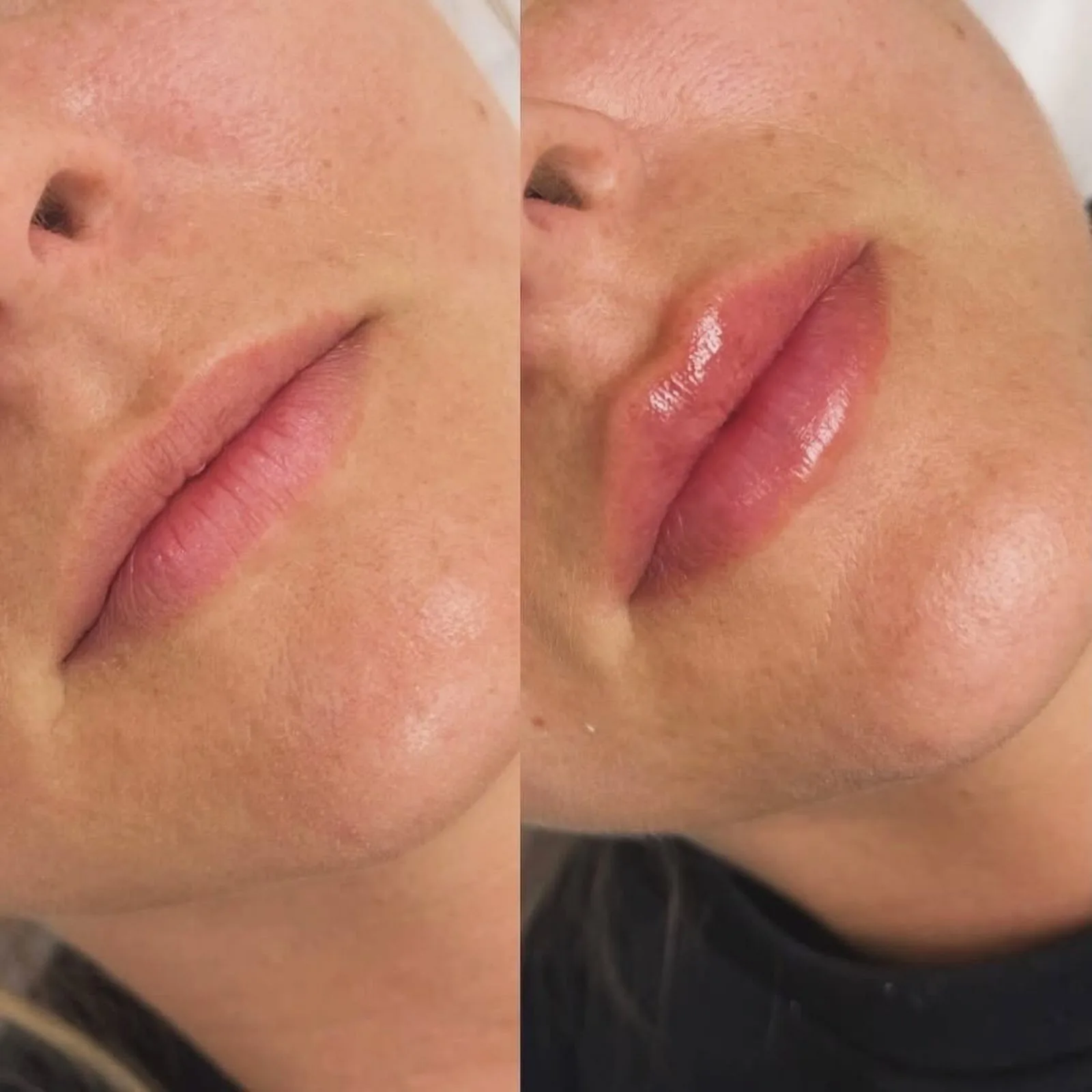 Before and after lip filler at BHRC, restored volume