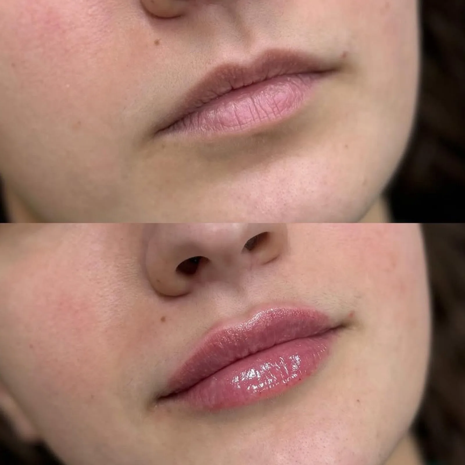 Before and after lip filler at BHRC, subtle enhancement