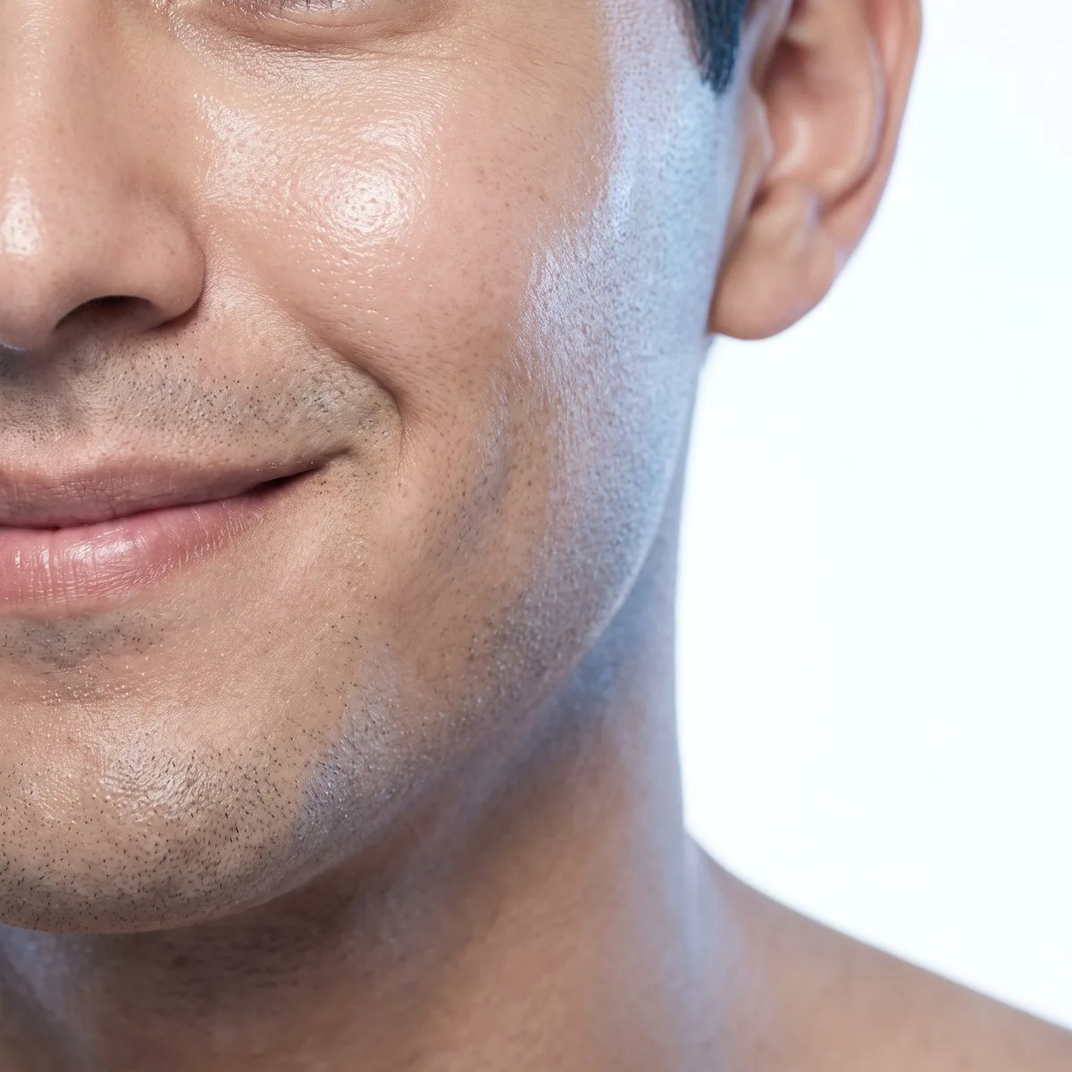 Refined skin texture after microneedling for acne scarring at BHRC