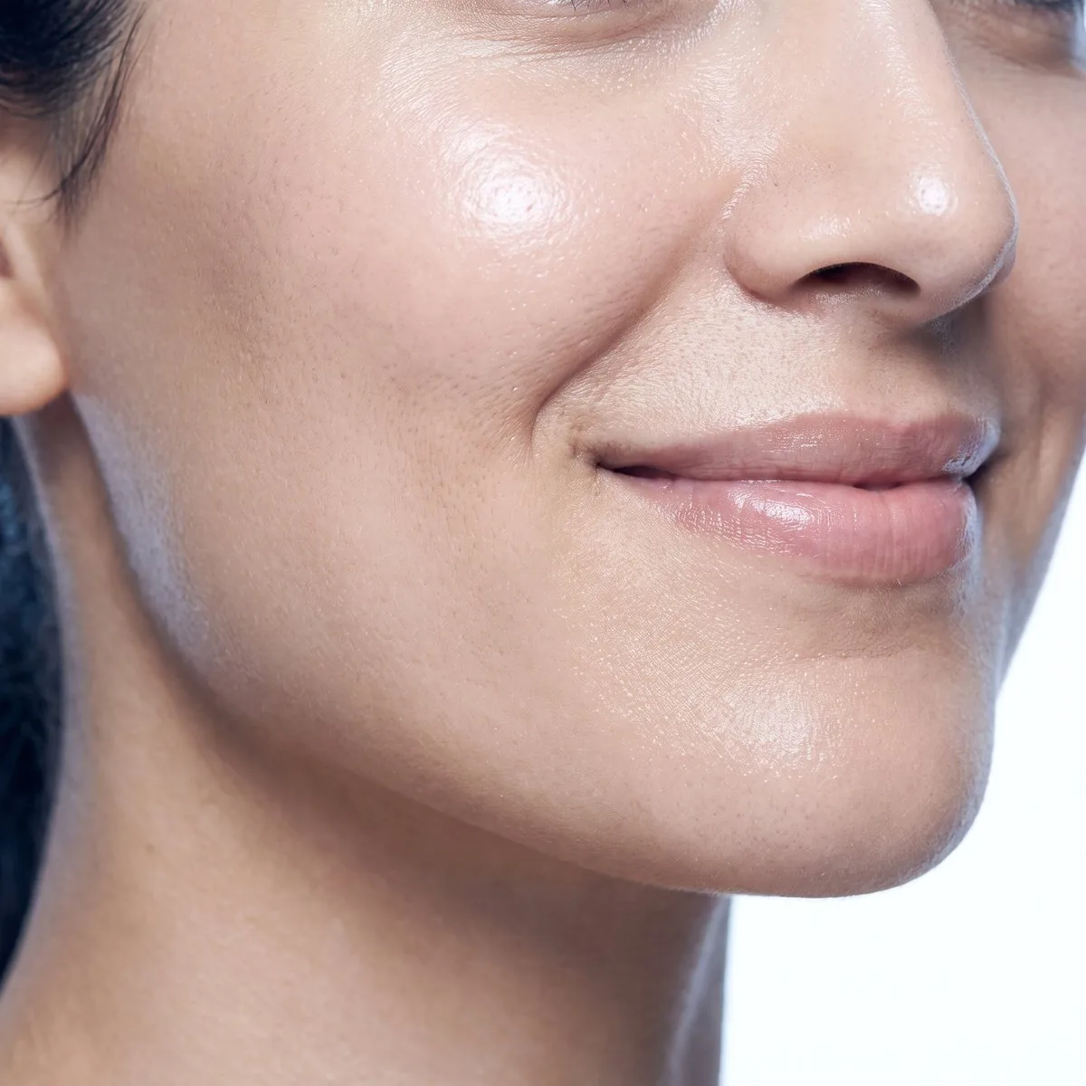 Close-up of a cheek with improved acne scarring after PRP at BHRC