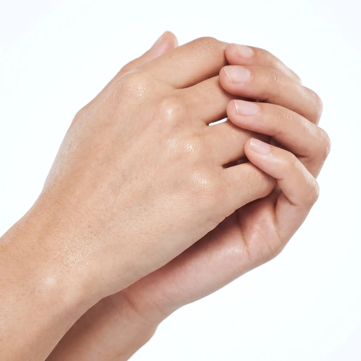Close-up of the backs of the hands after treatment at BHRC