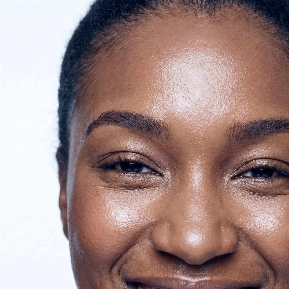 Close-up of a lifted brow area after Ultherapy at BHRC