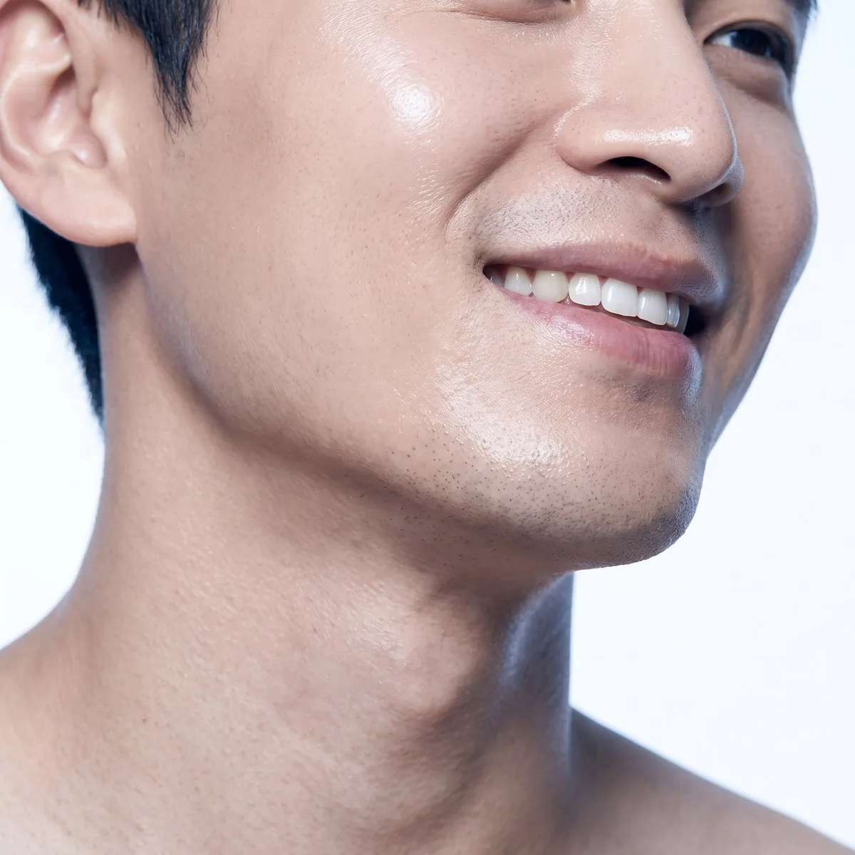 Close-up of a tightened submental area after Ultherapy at BHRC