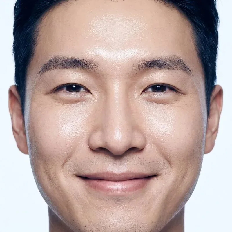 Close-up of a man's face at the frown-line (glabella) area treated with Botox.